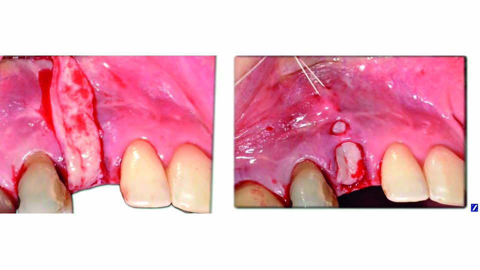 bone spicules after tooth extraction